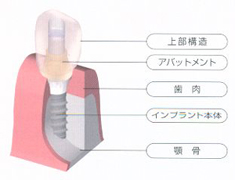 インプラント